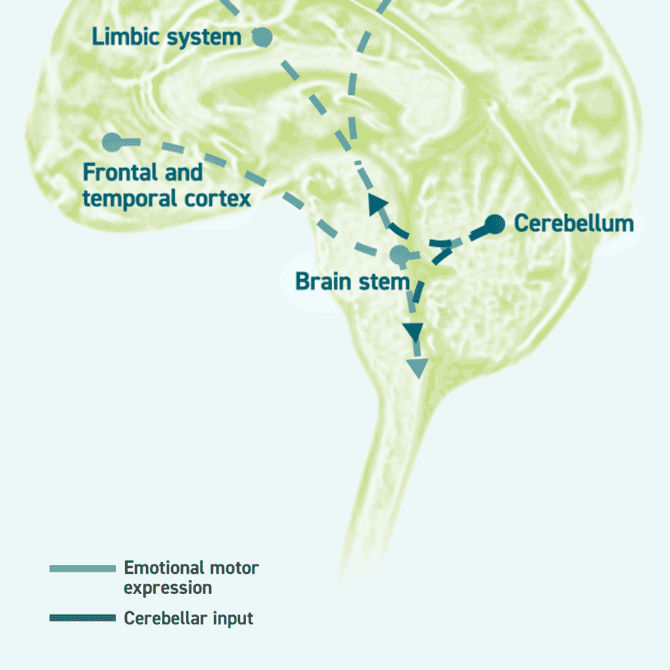 Brain depicting how neural damage can cause involuntary crying or laughing in patients